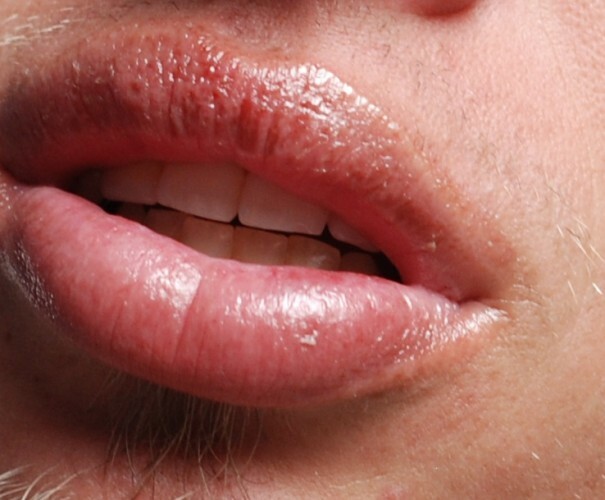 GALLERY 13 of the worst sunburn pictures we could find · The Daily Edge