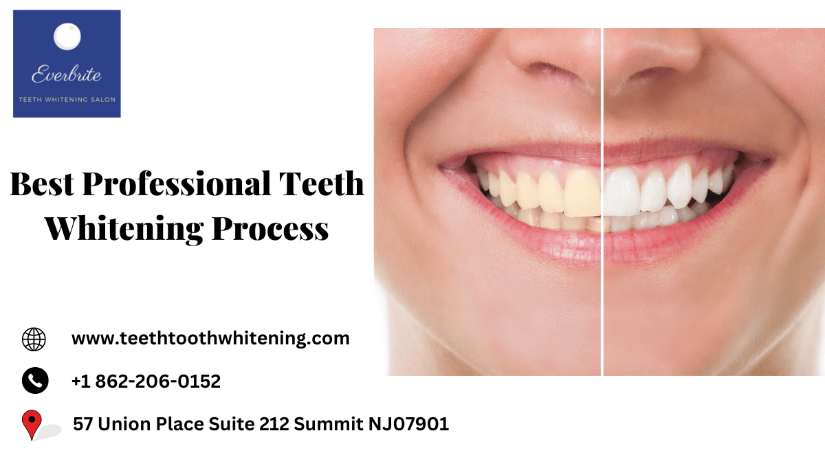 Best Professional Teeth Whitening Process ImgPile