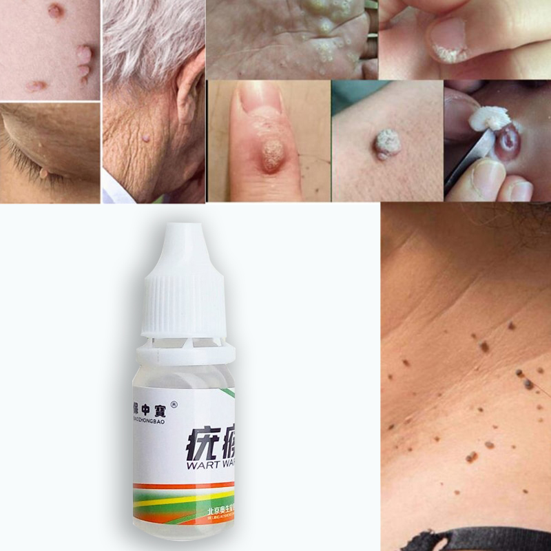 Genital Wart Treats Papillomas Removes Warts Liquid form SkinTags
