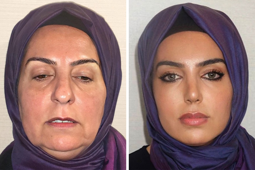 JawDropping Before And After Pics From Turkish Plastic Surgery Clinic