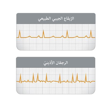 10- الرجفان الأذيني