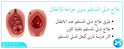 2- أسباب انسداد المستقيم عند الأطفال