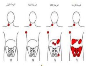 2_ عوامل الخطر لسرطان الغدد الليمفاوية هودجكين