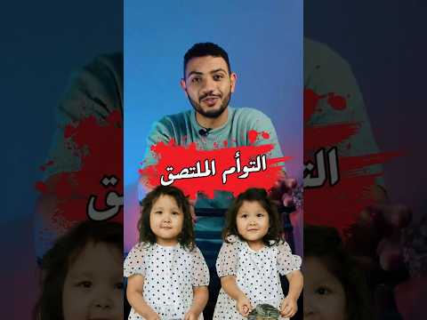 ارتباط التوأم الملتصق