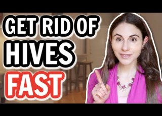  10 TIPS TO GET RID OF HIVES Dermatologist DrDrayzday