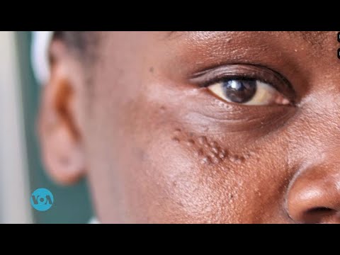 MAISHA NA AFYA Tunaangazia Vinyama Vidogo Au Visunzua Vinavyojitokeza Kwenye Ngozi Ya Binadamu