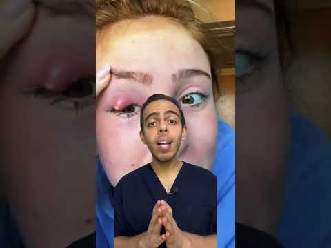 خراج جفن العين Medicine Short طب