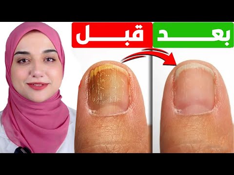 Never Ignore Yellowing Nails A Quick And Effective Treatment For Nail And Foot Fungus Never Ignore Yellowing Nails A Quick And Effective Treatment For Nail And Foot Fungus