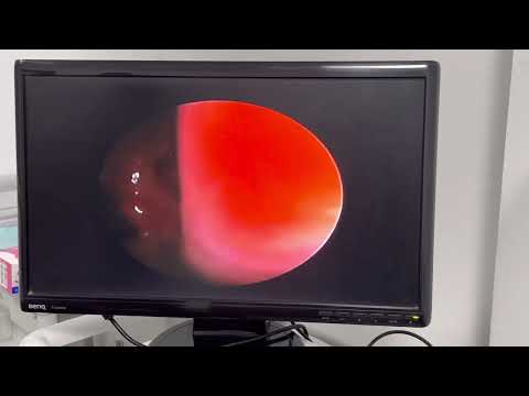 علاج الجيوب الأنفية بالمنظار و راى الحاله بعد العمليه علاج الجيوب الأنفية بالمنظار و راى الحاله بعد العمليه