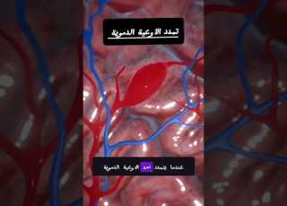 خطورة تمدد الأوعية الدموية في الدماغ
