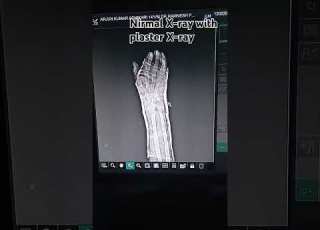 Normal Xray With Plaster X Ray Shorts Ytshorts Youtubeshorts Youtube
