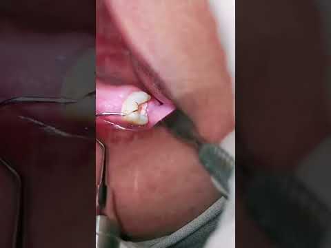 كسر الضرس بسبب تسوس الأسنان الشديد