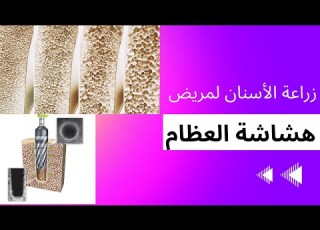 زراعة الاسنان لمريض هشاشة العظام