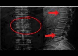  إزاي تقرأ أشعة الفقرات القطنية How To Read X Ray Of Lumbosacral Spine