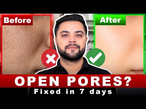 7 Days Open Pores Treatment Blackheads Enlarged Pores Acne Treatment 7 Days Open Pores Treatment Blackheads Enlarged Pores Acne Treatment