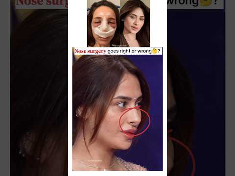 Surgery Goes Right Or Wrong Shorts Mahirasharma Bollywood Cosmeticsurgery Rhinoplasty