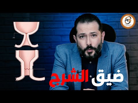 What Is Anal Stenosis Its Main Causes And Treatment Methods With Dr Rami Salah Eldin