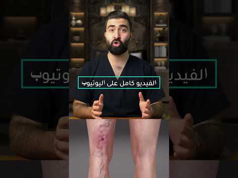 Are Varicose Veins A Serious Disease Are Varicose Veins A Serious Disease