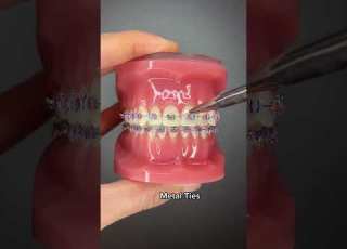 Different Types Of Orthodontic Ties You Can Get At Your Orthodontist Part 1