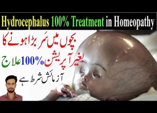  Hydrocephalus Treatment Hydrocephalus Treatment Without Surgery Hydrocephalus In Pediatrics In Hindi