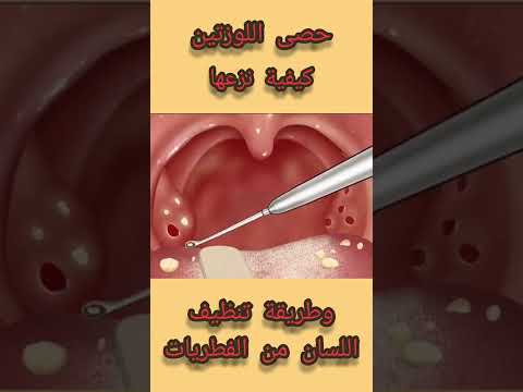حصى اللوزتين علاجها وطريقة تنظيف اللسان من الفطريات