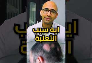 السبب الحقيقي لمرض الثعلبة