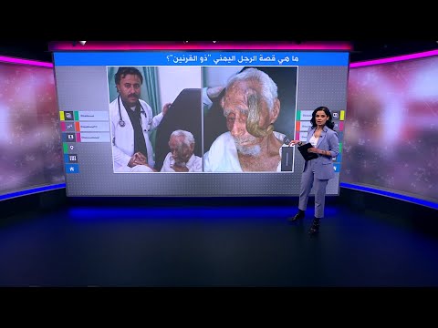 ذو القرنين ما قصة وفاة معمر يمني بعد بتر قرونه