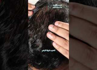 الأسباب الرئيسية وراء تساقط الشعر