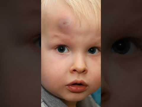 استعمالات كريم أرنيكا السحري على كدمات الصغار والكبار استعمالات كريم أرنيكا السحري على كدمات الصغار والكبار