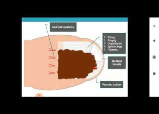  Rania Al Akad Dermoscopy Of The Nails 1