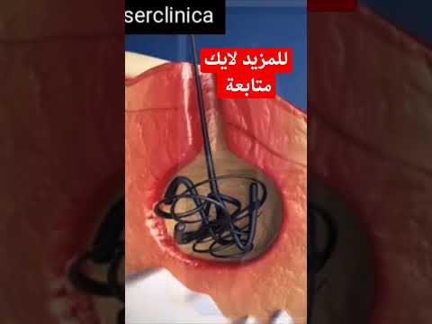 شاهد أزالة كيس الشعر من الناسور العصعصي