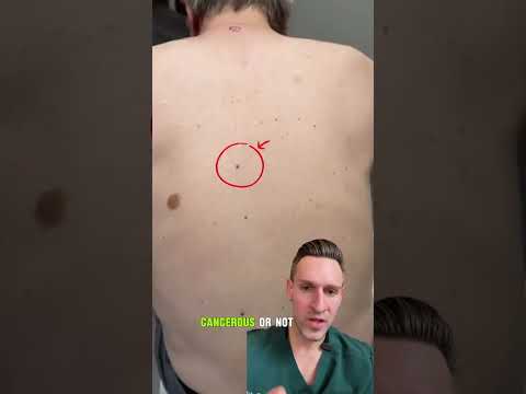 Your Skin Cancer Screening Exam May Be Missing Melanoma