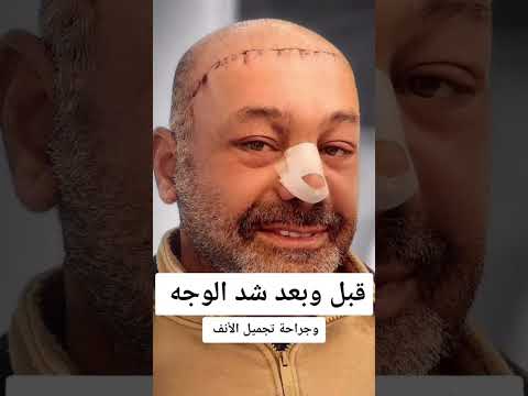 عمليه شد الوجه وتجميل الانف النتيجة قبل وبعد صدمة