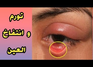 علاج تورم و انتفاخ العين و الجفون بكل سهولة و ما هي أسباب تورم العين