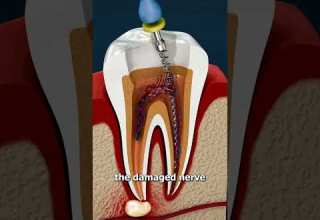 What Is A Root Canal 