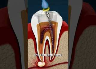What Is A Root Canal