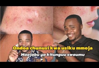 Ondoa Chunusi Kwa Usiku Mmoja Tu Kwa Kutumia Kitunguu Swaumu