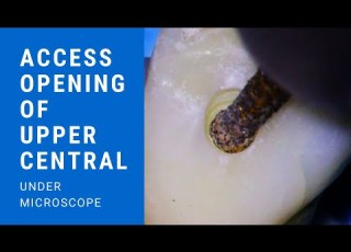 Access Opening Of Upper Central Incisor Under Microscope Aspire32