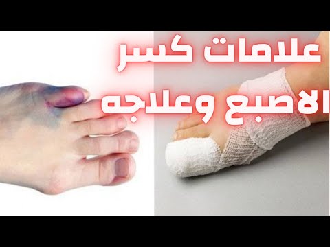 علامات كسر الاصبع وعلاجه كسر اصبع القدم كسر اصبع في القدم التئام العظام التئام الكسور