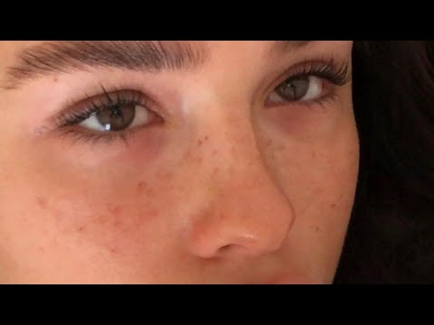 ღ Your Nose Tip Is So Small Nose Tip Reduction Procedure