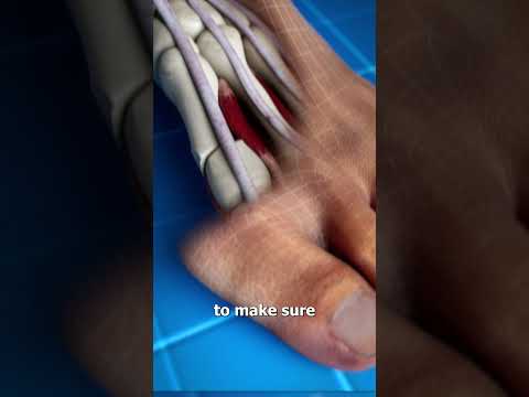 Bunion Correction Explained