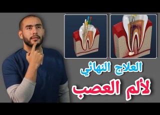  علاج الم الاسنان وحشو العصب التهاب العصب الأسباب والعلاج علاج الم العصب