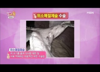 엄지의 제왕 당뇨병 치료 수술법 전격 공개 엄지의 제왕 322회
