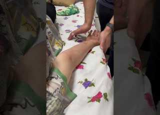  سندرم تونل کارپال