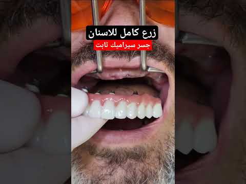 زرع اسنان لكامل الفم وتركيب جسر سيراميك ثابت