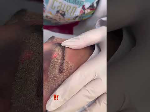 وداعا لشد الجفون الجراحي اكسبلور Laser ترند Skincare Beauty وداعا لشد الجفون الجراحي اكسبلور Laser ترند Skincare Beauty