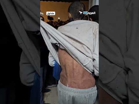 شاهد بجسد هزيل وأمراض جلدية أسير محرر يكشف معاناة الأسرى الفلسطينيين في سجون الاحتلال