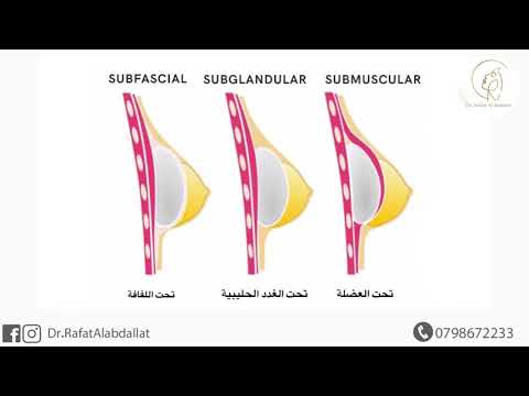 ما بعد عملية تكبير الثدي الاثار الجانبية ما بعد عملية تكبير الصدر