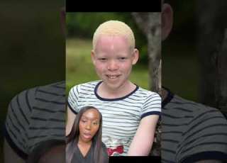 Albinism Understanding The Genetic Condition And Its Impact