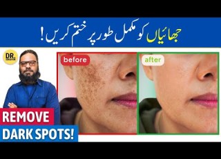 Chehre Ki Chaiyan Jhaiya Ka Khatma Fade Hyperpigmentation Dark Age Spots